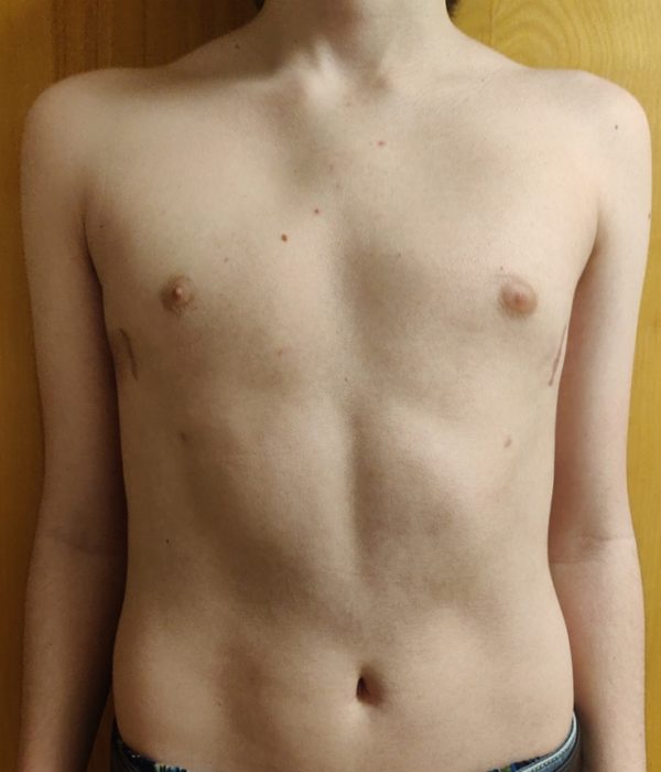 LA Pectus Brace Types of Pectus Carinatum LA Pectus Brace